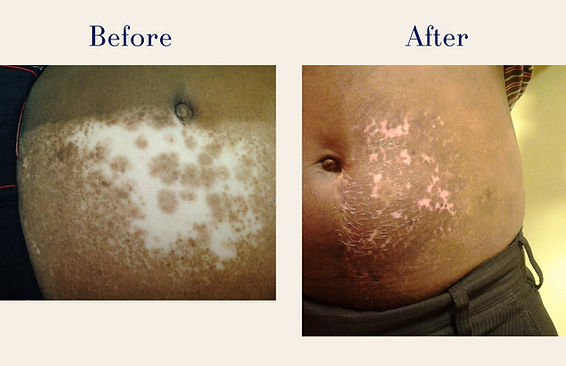 Vitiligo (1)