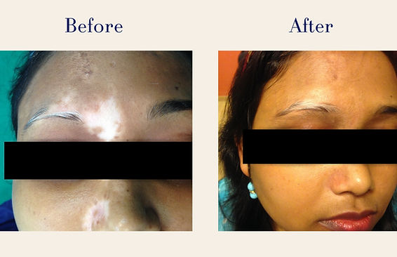 Vitiligo (2)