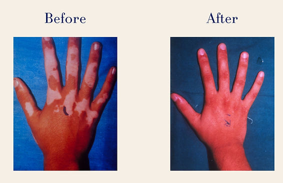 Vitiligo (3)
