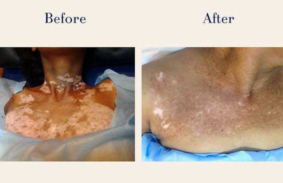 Vitiligo (4)