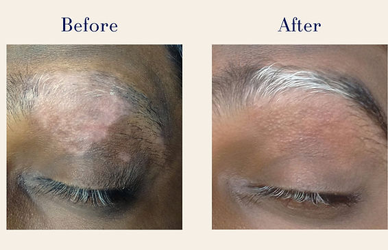 Vitiligo (5)