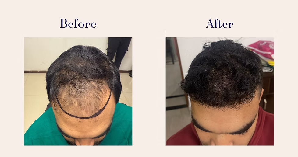 hair-transplant-1
