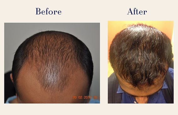 hair-transplant (1)
