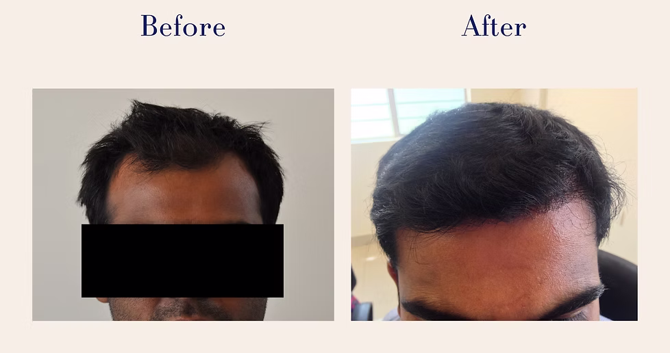 hair-transplant-2