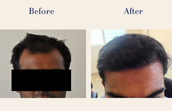 hair-transplant (2)