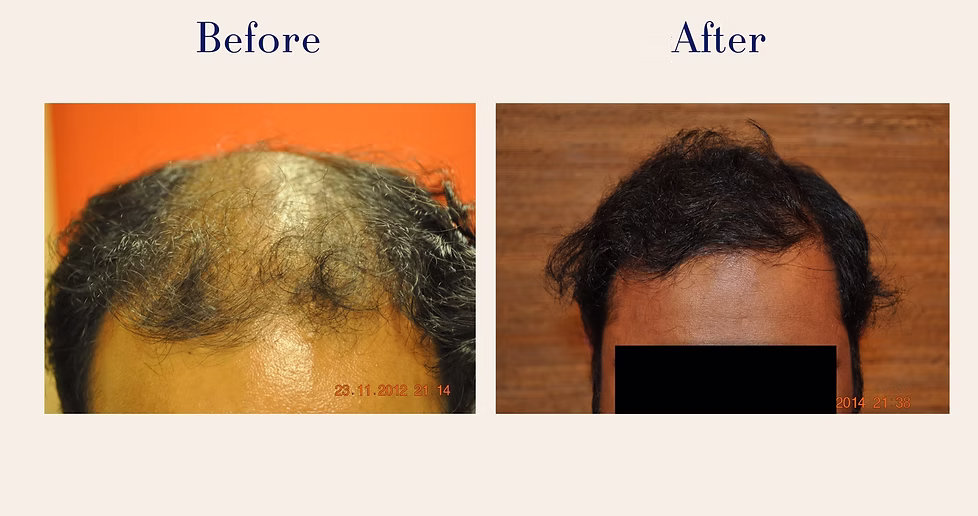 hair-transplant-3