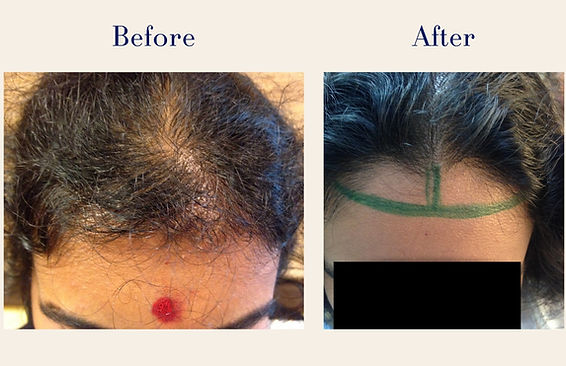 hair-transplant (3)