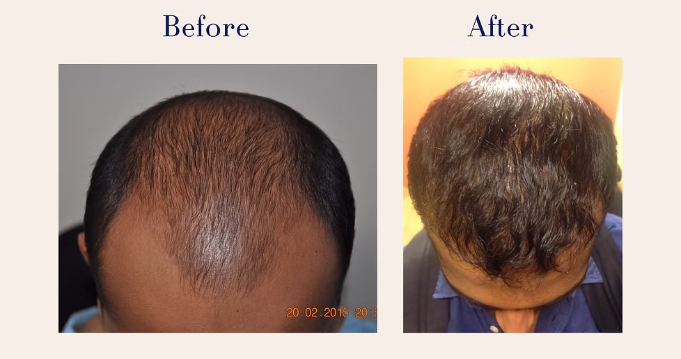 hair-transplant-4
