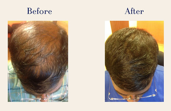 hair-transplant (4)