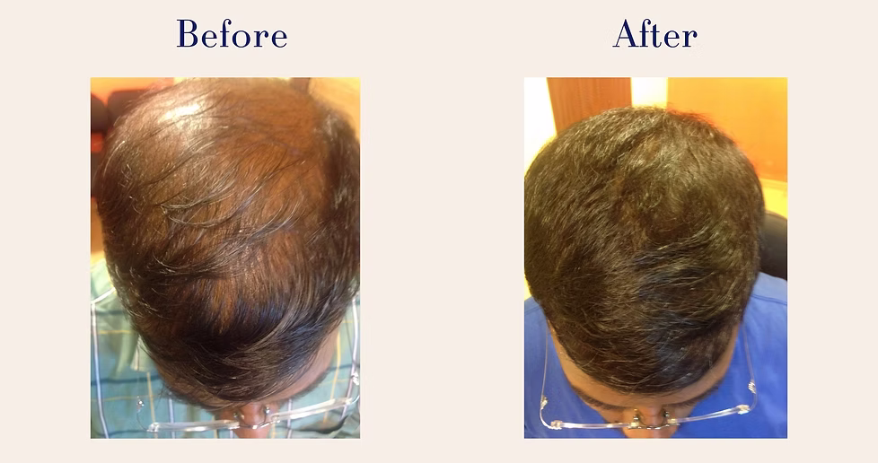 hair-transplant-5