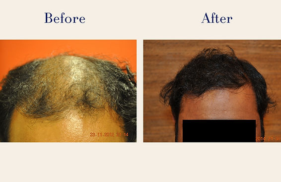 hair-transplant (5)