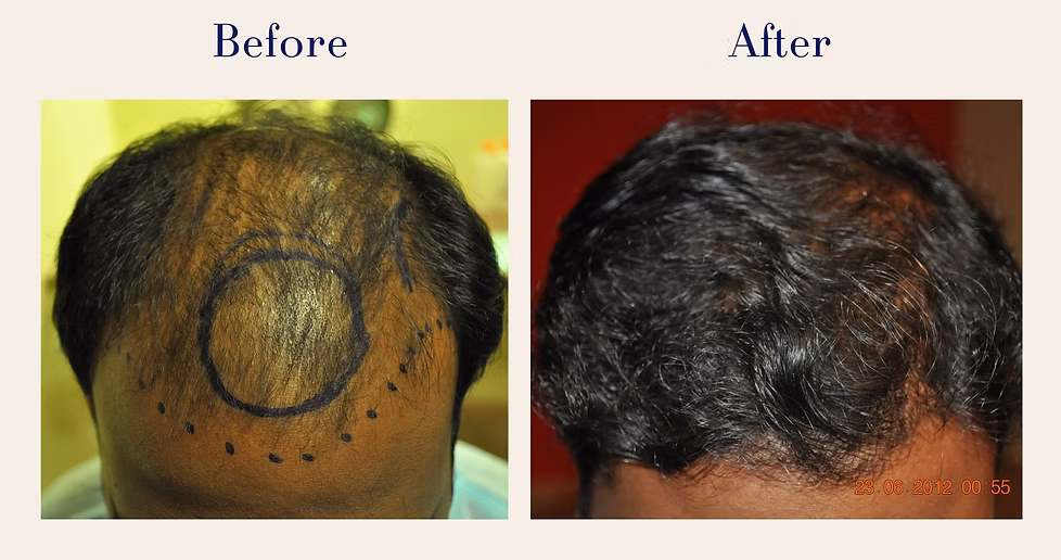 hair-transplant-6