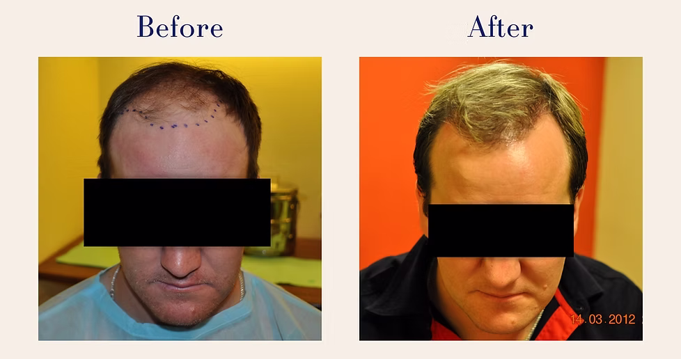 hair-transplant-7