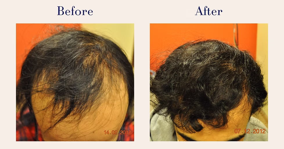 hair-transplant-8