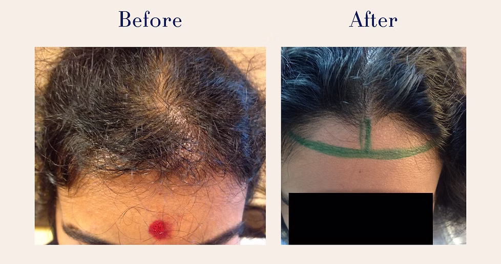 hair-transplant-9