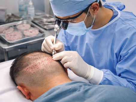 Hair Transplant Results in Bangalore: Why Proper Graft Planning Matters